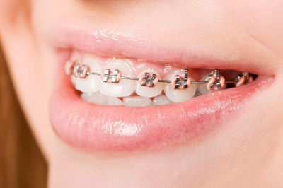 MAINTAINING GOOD ORAL HEALTH WITH BRACES