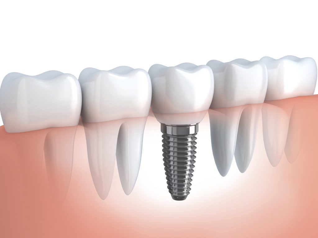 Considering Getting a Dental Implant? Here’s What You Must Know!